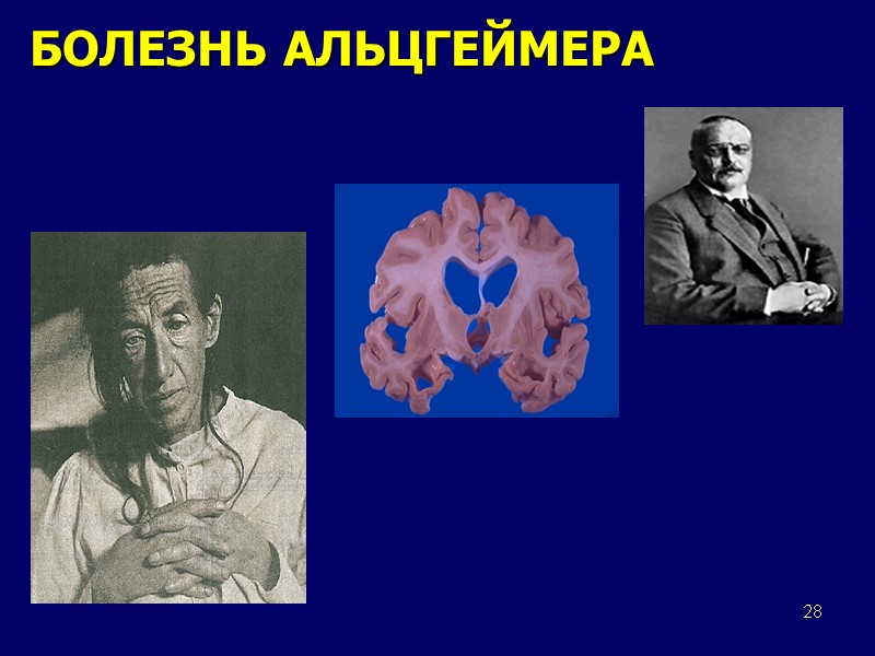 28 БОЛЕЗНЬ АЛЬЦГЕЙМЕРА